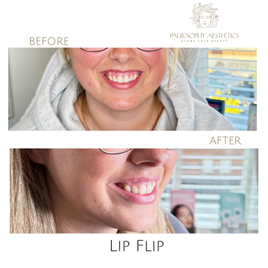 Lip Flip