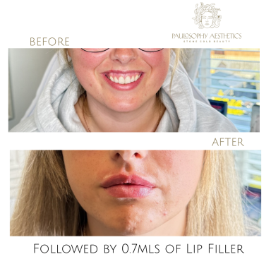 Lip Filler