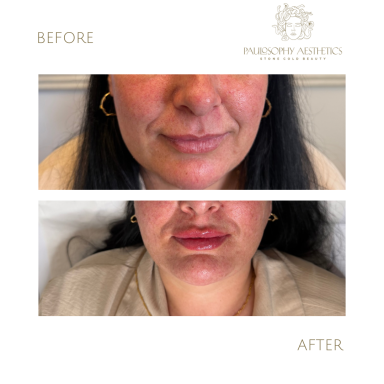 Lip Filler